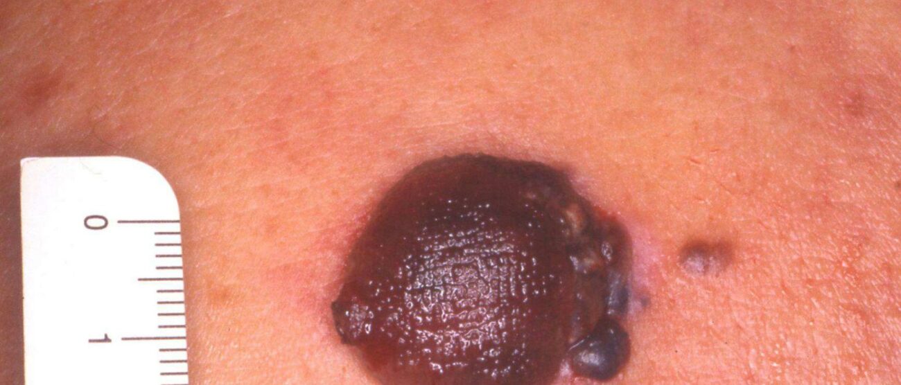 EuroMelanoma DayGli ambulatori aperti