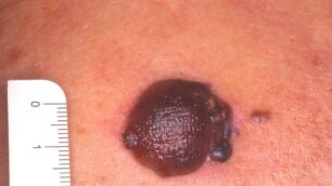 EuroMelanoma DayGli ambulatori aperti